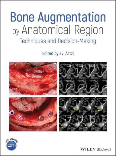 Image of - Bone Augmentation By Anatomical Region Techniques And Decision Making | Hardcover