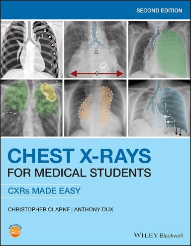 Image of - Chest X Rays For Medical Students Cxrs Made Easy 2nd Edition | Paperback