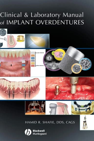 Image of - Clinical and Laboratory Manual of Implant Overdentures | Hardcover