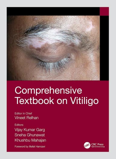 Image of - Comprehensive Textbook On Vitiligo | Hardcover