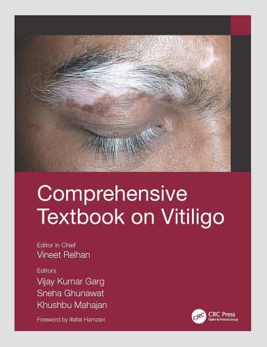 Image of - Comprehensive Textbook On Vitiligo | Paperback