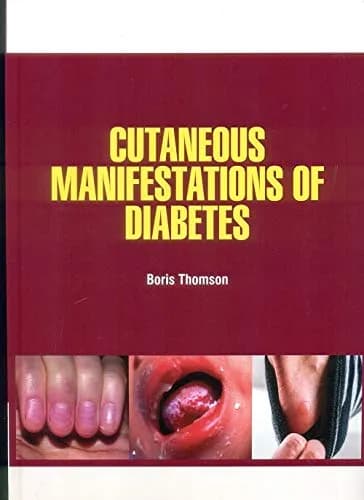 Image of - Cutaneous Manifestations of Diabetes | Hardcover