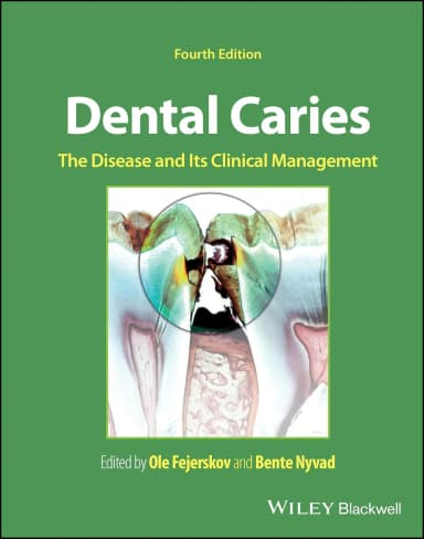 Image of - Dental Caries The Disease And Its Clinical Management 4th Editiond | Hardcover