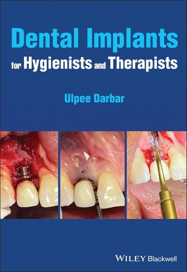 Image of - Dental Implants For Hygienists And Therapists | Paperback