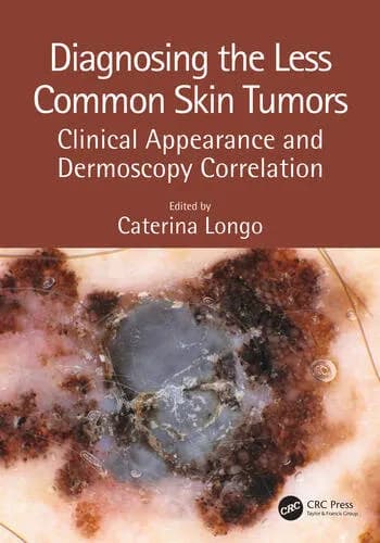 Image of - Diagnosing the Less Common Skin Tumors | 1st Edition | Hardcover