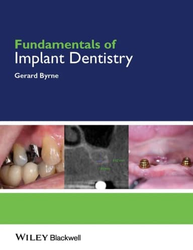 Image of - Fundamentals of Implant Dentistry | Paperback