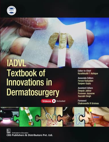 Image of - Iadvl Textbook Of Innovations In Dermatosurgery | Hardcover