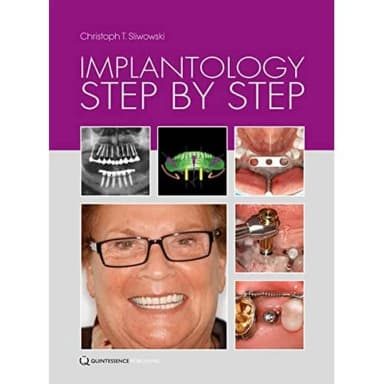 Image of - Implantology Step by Step | Hardcover