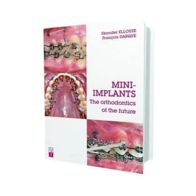 Image of - Mini-Implants The orthodontics of the future | Hardcover