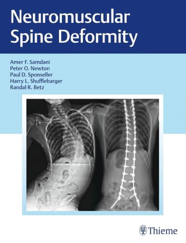 Image of - Neuromuscular Spine Deformity | Hardcover