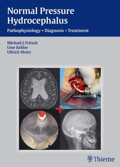 Image of - Normal Pressure Hydrocephalus Pathophysiology | Diagnosis | Treatment | Hardcover