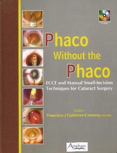 Image of - Phaco Without The Phaco