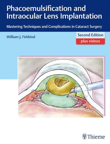 Image of - Phacoemulsification and Intraocular Lens Implantation | 2nd Edition | Hardcover