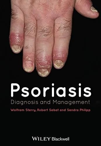 Image of - Psoriasis Diagnosis and Management | Hardcover