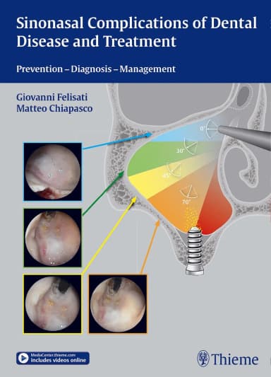 Image of - Sinonasal Complications of Dental Disease and Treatment | Hardcover