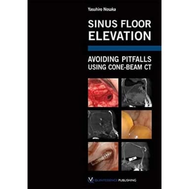 Image of - Sinus Floor Elevation Avoiding Pitfalls Using Cone-Beam CT | Hardcover