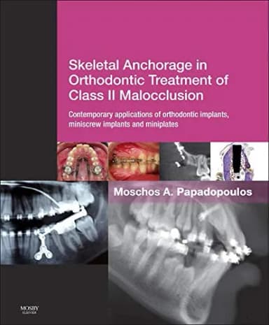 Image of - Skeletal Anchorage in Orthodontic Treatment of Class II Malocclusion | Hardcover