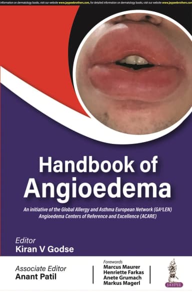 Image of - Handbook Of Angioedema | Paperback