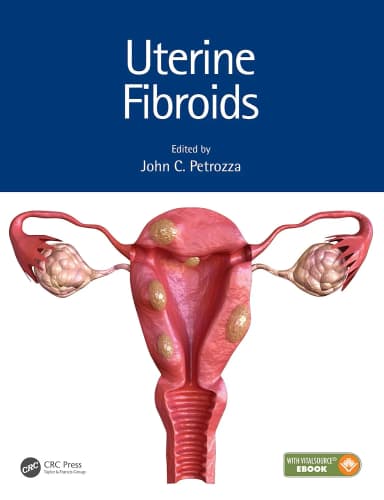 Image of - Uterine Fibroids | Hardcover