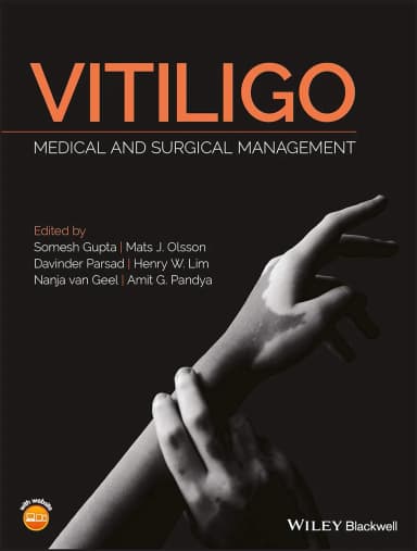 Image of - Vitiligo Medical and Surgical Management | Hardcover