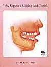 Image of - Why Replace a Missing Back Tooth? | 2nd Edition | Paperback