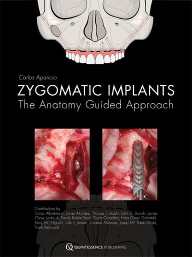Image of - Zygomatic Implants The Anatomy-Guided Approach | Hardcover