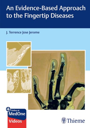 Image of - An Evidence-Based Approach To The Fingertip Diseases 1st Ed.