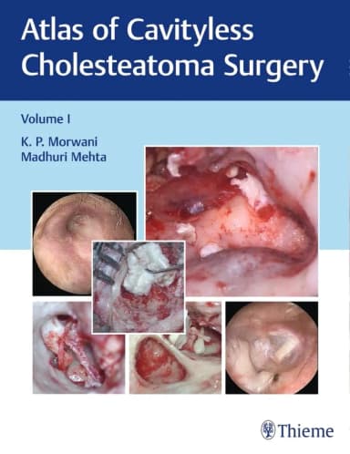 Image of - Atlas of Cavityless Cholesteatoma Surgery (Volume 1)