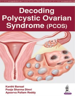 decoding-polycystic-ovarian-syndrome-pcos-1st-edition