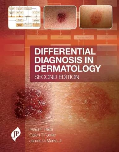 Image of - Differential Diagnosis in Dermatology - 2nd Edition