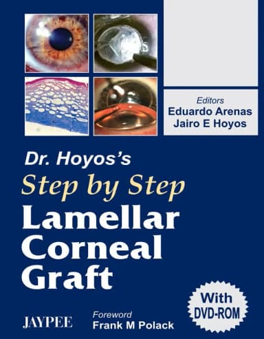 Thumbnail - Dr.hoyos Step by Step Lamellar Corneal Graft - 1st Edition