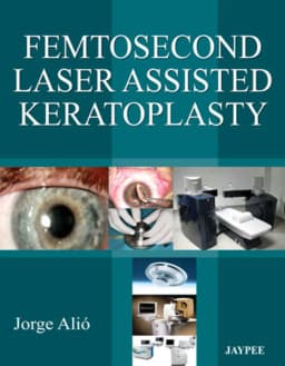 femtosecond-laser-assisted-keratoplasty-1st-edition