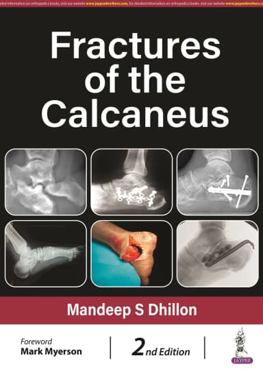 Image of - Fractures of the Calcaneus