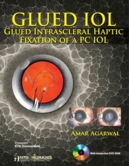 glued-intrascleral-haptic-fixation-pc-iol-1st-edition