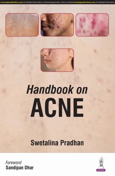 Image of - Handbook on Acne