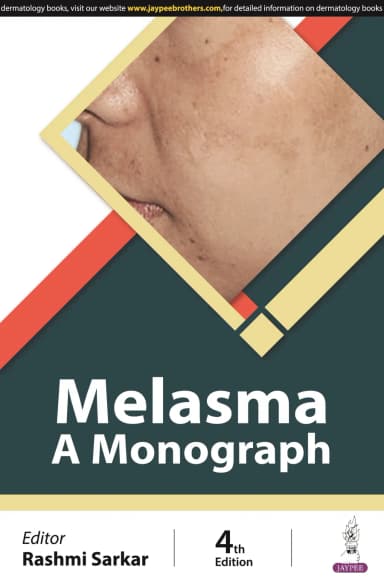 Image of - Melasma | A Monograph