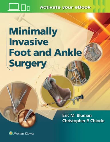 Image of - Minimally Invasive Foot and Ankle Surgery - 1st Edition