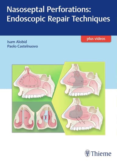 Image of - Nasoseptal Perforations: Endoscopic Repair Techniques 1st Edition