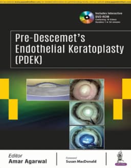 pre-descemets-endothelial-keratoplasty-1st-edition