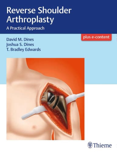 Image of - Reverse Shoulder Arthroplasty 1st Edition