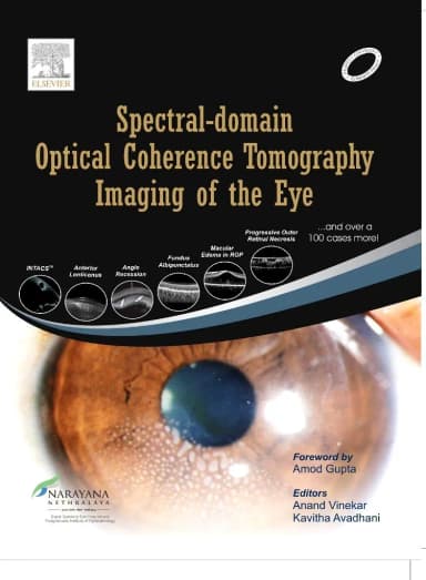 Image of - Spectral Domain Optical Coherence Tomography Imaging of the Eye