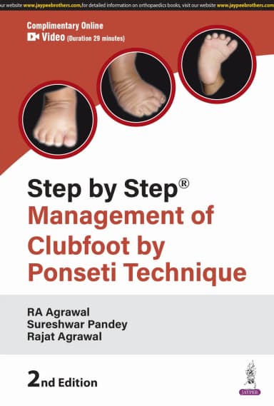 Image of - Step by Step Management of Clubfoot by Ponseti Technique