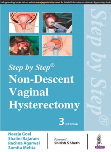 Image of - Step By Step Non-descent Vaginal Hysterectomy - 3rd Edition