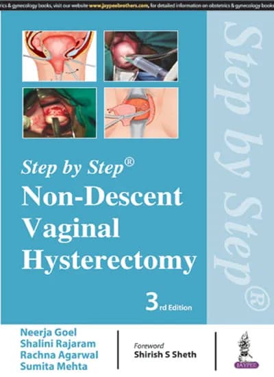 Step By Step Non-descent Vaginal Hysterectomy - 3rd Edition