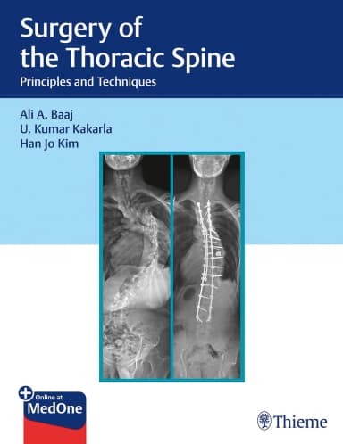 Image of - Surgery of the Thoracic Spine 1st Edition