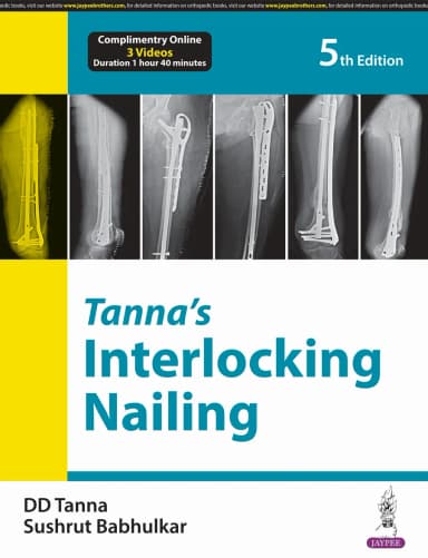 Image of - Tanna's Interlocking Nailing