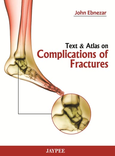 Image of - Text and Atlas on Complications of Fractures - 1st Edition