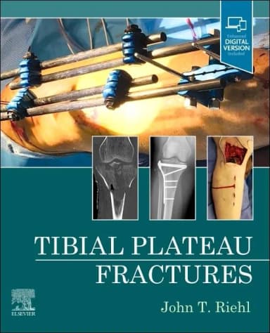 Image of - Tibial Plateau Fractures-1E