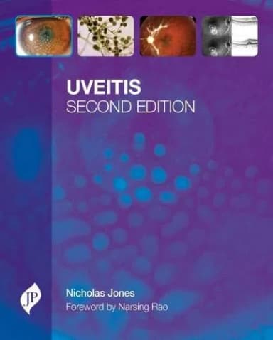 Image of - Uveitis with CD-ROM - 2nd Edition 2013