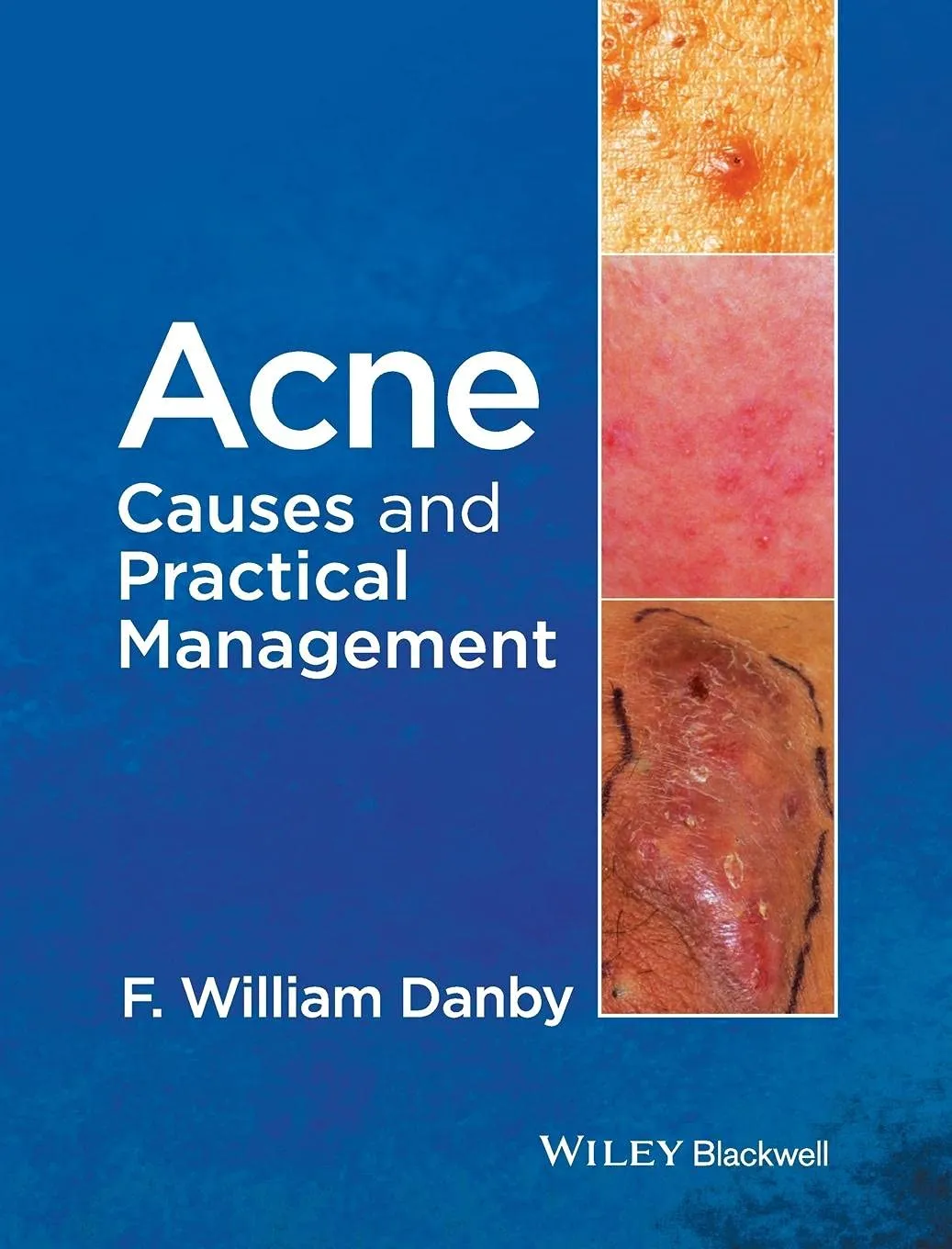 ACNE Causes and Practical Management | Hardcover